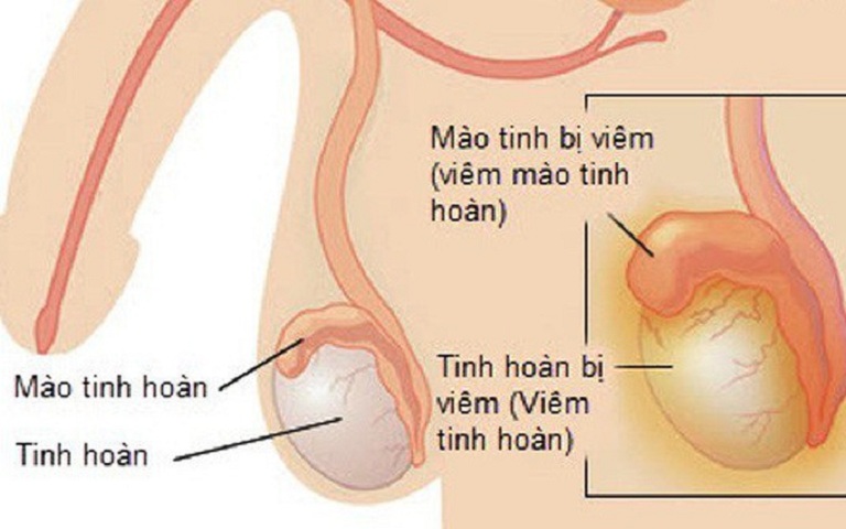 Biến chứng phổ biến nhất là viêm mào tinh hoàn